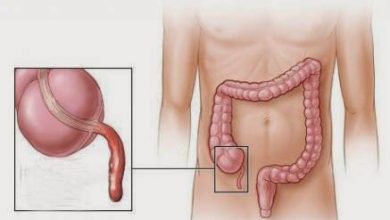 Photo of كيف يتعرف المريض على آلام الزائدة الدودية؟ التهاب الزائدة الدودية appendicitis